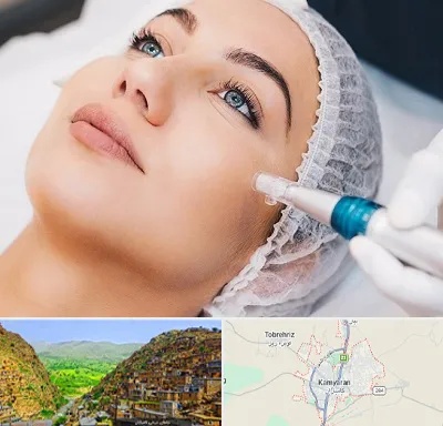 مزونیدلینگ در کامیاران