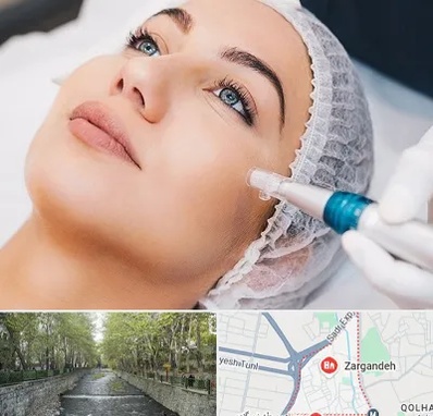 مزونیدلینگ در زرگنده