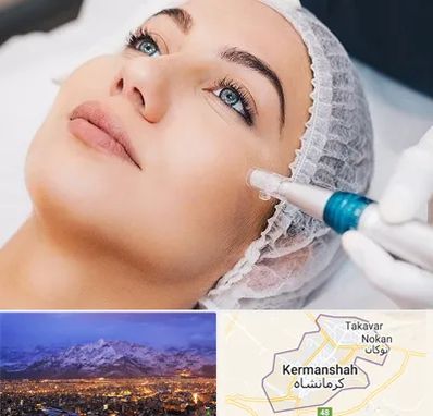 مزونیدلینگ در کرمانشاه