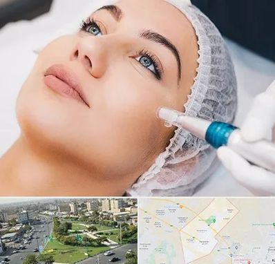 مزونیدلینگ در کمال شهر کرج