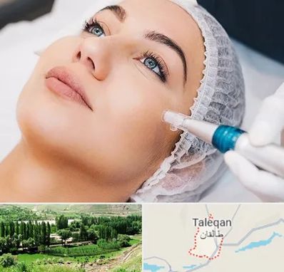 مزونیدلینگ در طالقان