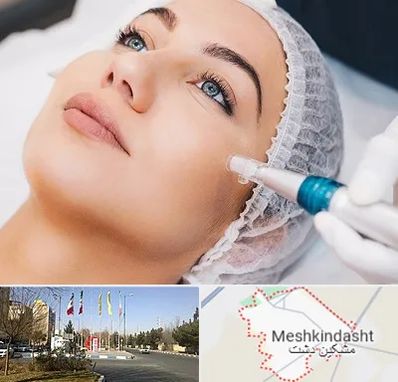 مزونیدلینگ در مشکین دشت