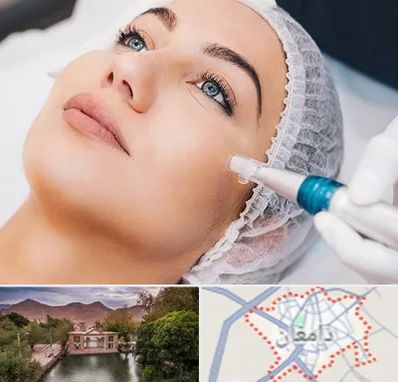 مزونیدلینگ در دامغان