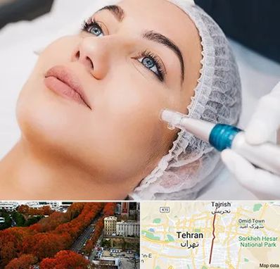 مزونیدلینگ در ولیعصر 