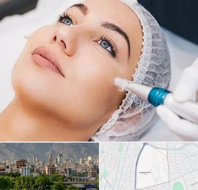 مزونیدلینگ در جمشیدیه