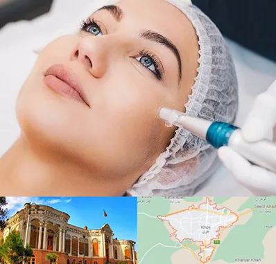 مزونیدلینگ در خوی