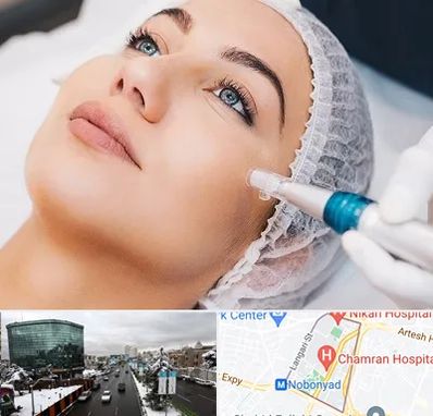 مزونیدلینگ در اقدسیه 