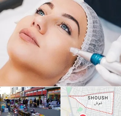 مزونیدلینگ در شوش