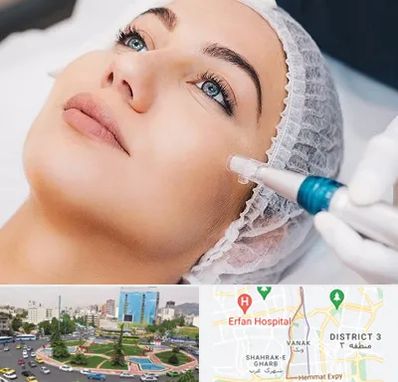 مزونیدلینگ در ونک 