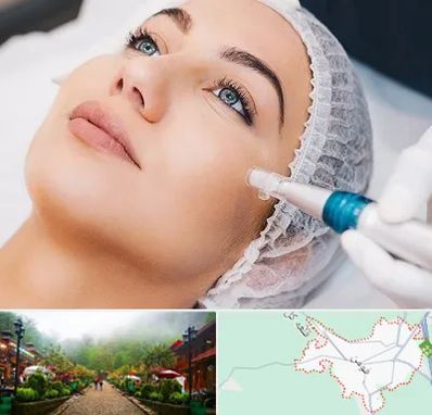 مزونیدلینگ در فومن