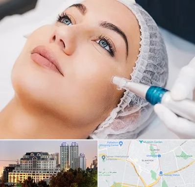 مزونیدلینگ در فرشته 