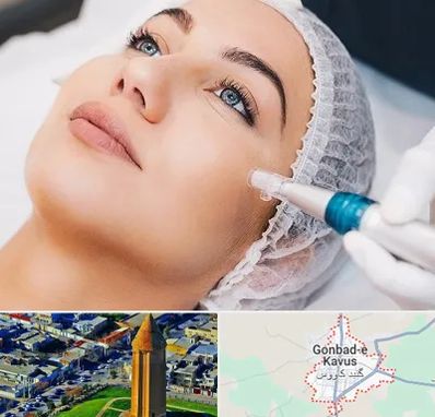 مزونیدلینگ در گنبد کاووس