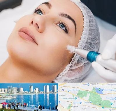 مزونیدلینگ در چیتگر 