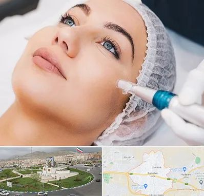 مزونیدلینگ در بومهن