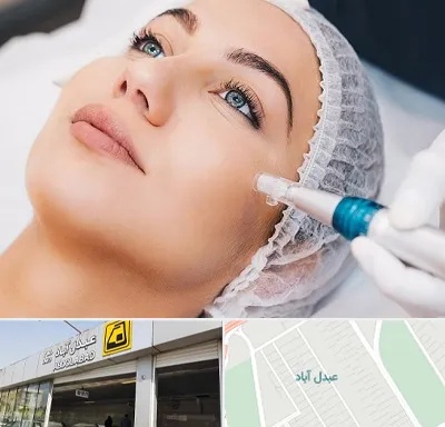 مزونیدلینگ در عبدل آباد