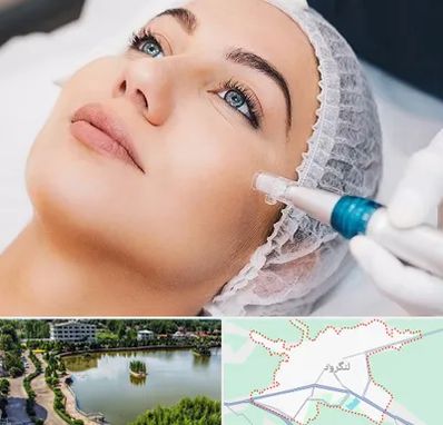 مزونیدلینگ در لنگرود