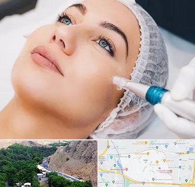 مزونیدلینگ در کن 