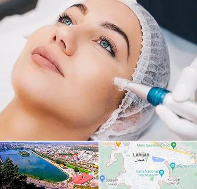 مزونیدلینگ در لاهیجان