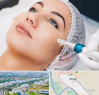 مزونیدلینگ در آبادان