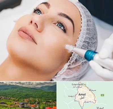 مزونیدلینگ در آمل