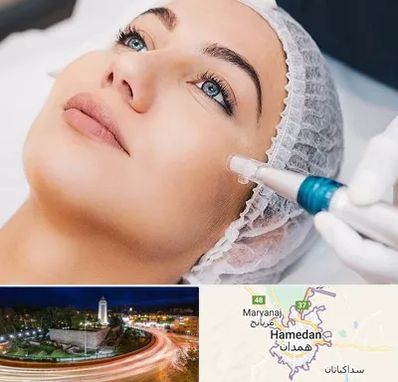 مزونیدلینگ در همدان