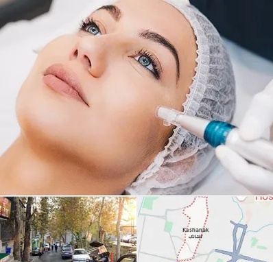 مزونیدلینگ در کاشانک