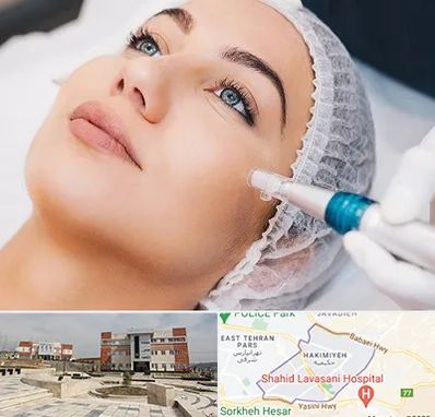 مزونیدلینگ در حکیمیه 