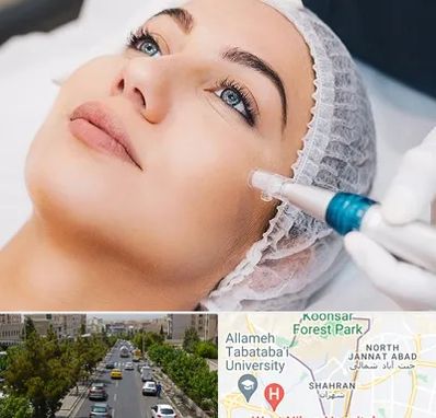 مزونیدلینگ در شهران 