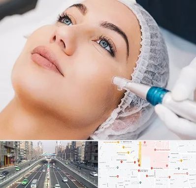 مزونیدلینگ در توحید 