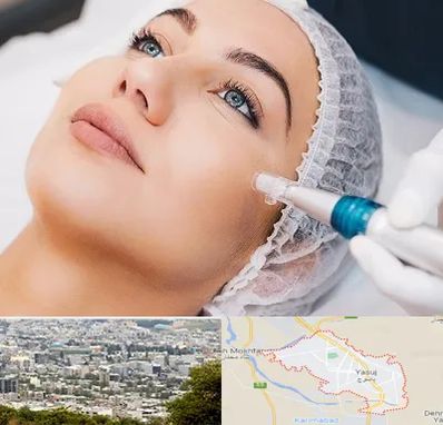 مزونیدلینگ در یاسوج