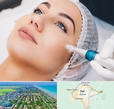 مزونیدلینگ در ساری