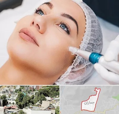 مزونیدلینگ در جماران