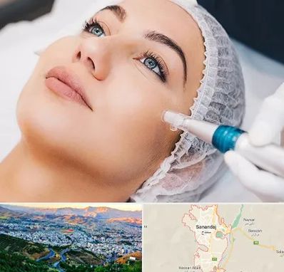 مزونیدلینگ در سنندج