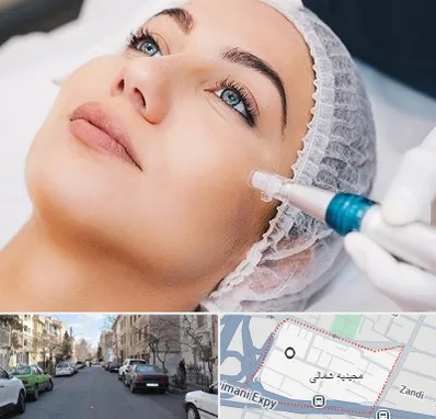 مزونیدلینگ در مجیدیه شمالی