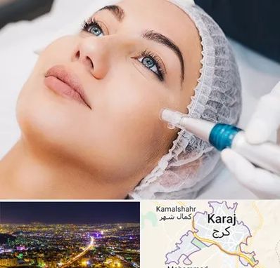 مزونیدلینگ در کرج