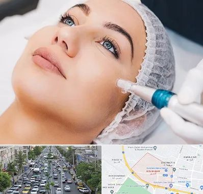 مزونیدلینگ در گلشهر کرج