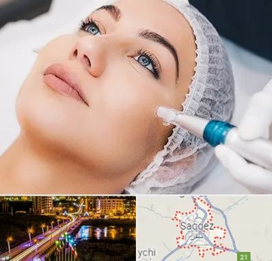 مزونیدلینگ در سقز