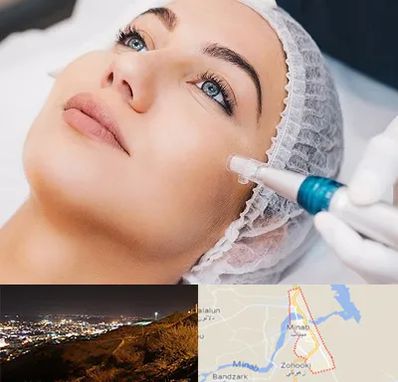 مزونیدلینگ در میناب