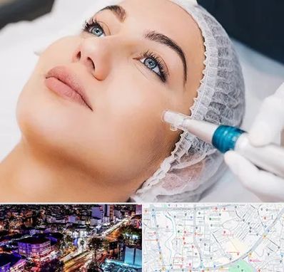 مزونیدلینگ در منظریه رشت