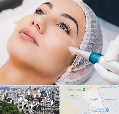 مزونیدلینگ در ولنجک 