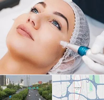 مزونیدلینگ در توانیر