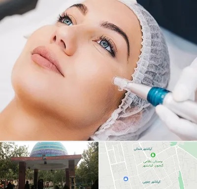 مزونیدلینگ در کیانشهر