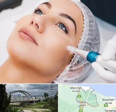 مزونیدلینگ در چالوس