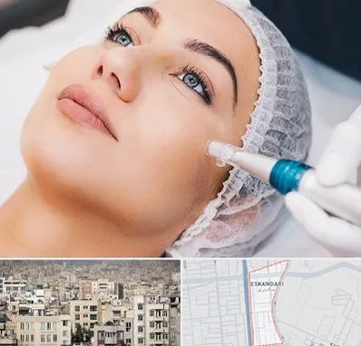 مزونیدلینگ در اسکندری