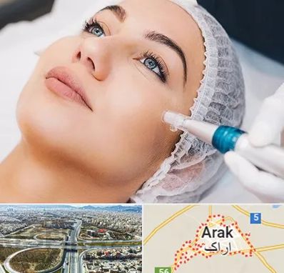 مزونیدلینگ در اراک