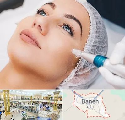 مزونیدلینگ در بانه