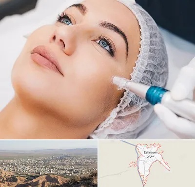 مزونیدلینگ در اسفراین