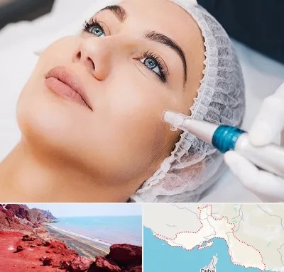 مزونیدلینگ در هرمزگان