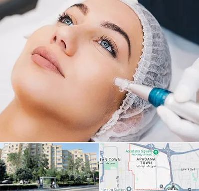 مزونیدلینگ در آپادانا