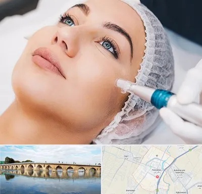مزونیدلینگ در فلاورجان